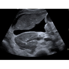 Abdominal Ultrasound (3 Day) April